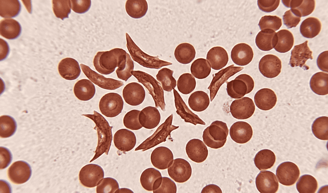 Sickle Cell Disease vs. Sickle Cell Trait: What You Need to Know